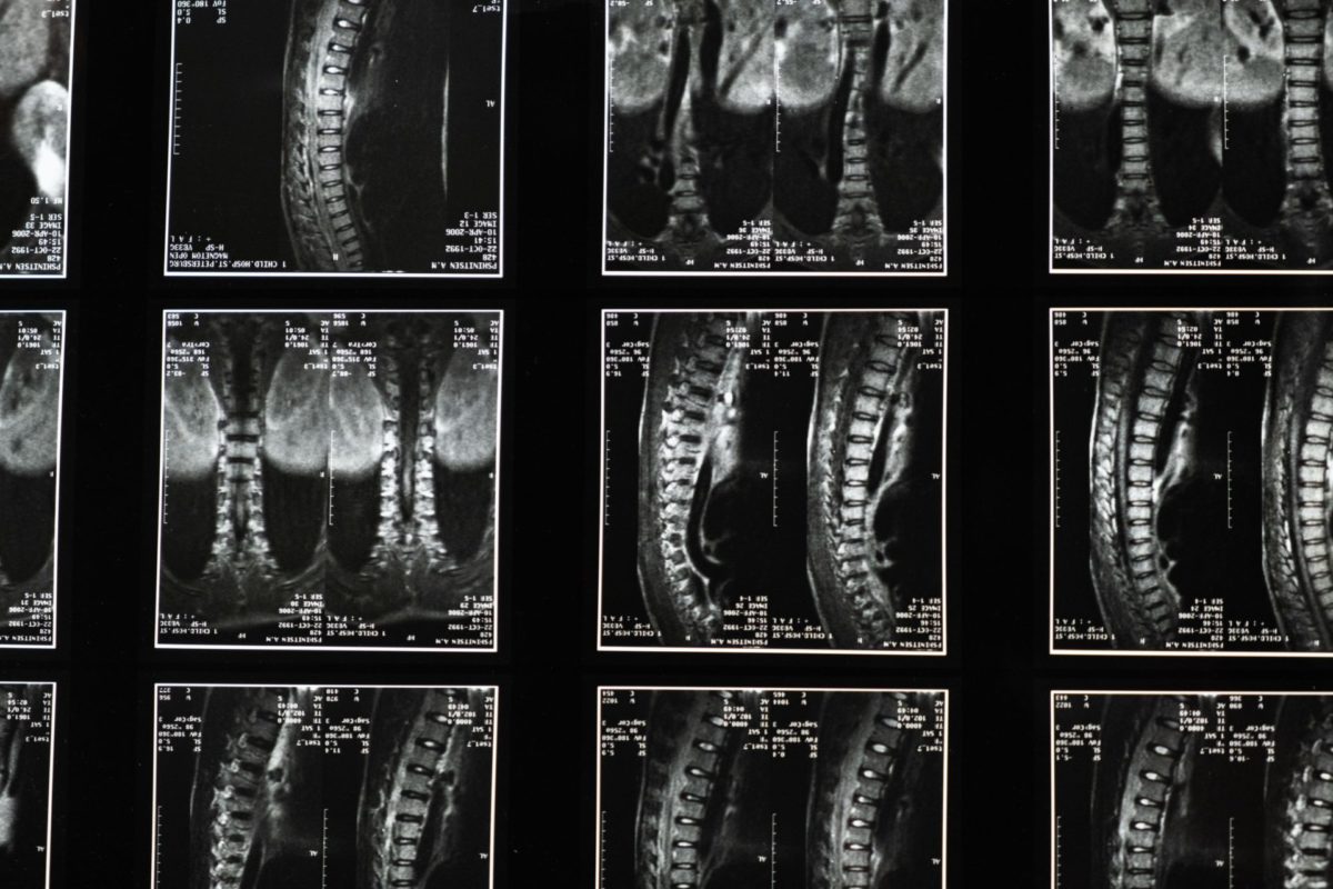 x-ray of spinal cord injury victim
