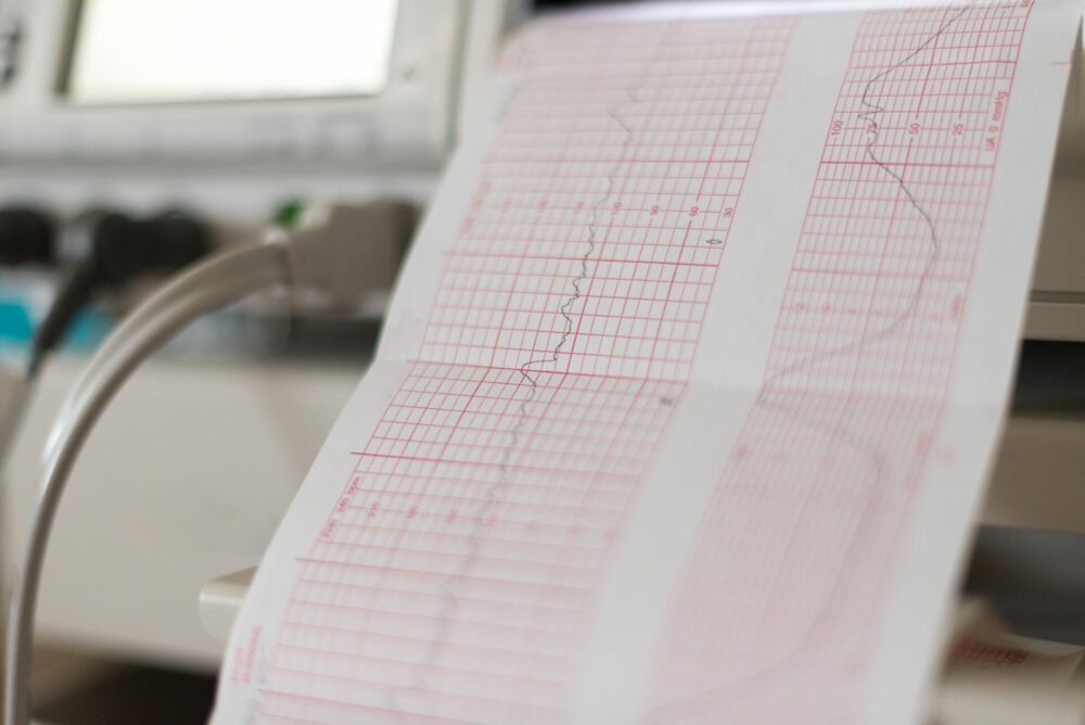 fetal monitoring strips for birth injury deposition