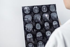 Doctor looking at a brain scan