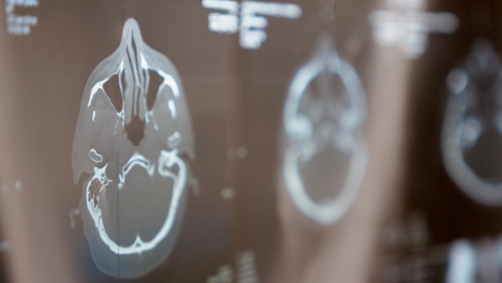 CT scan images showing traumatic brain injury patterns used in medical diagnosis